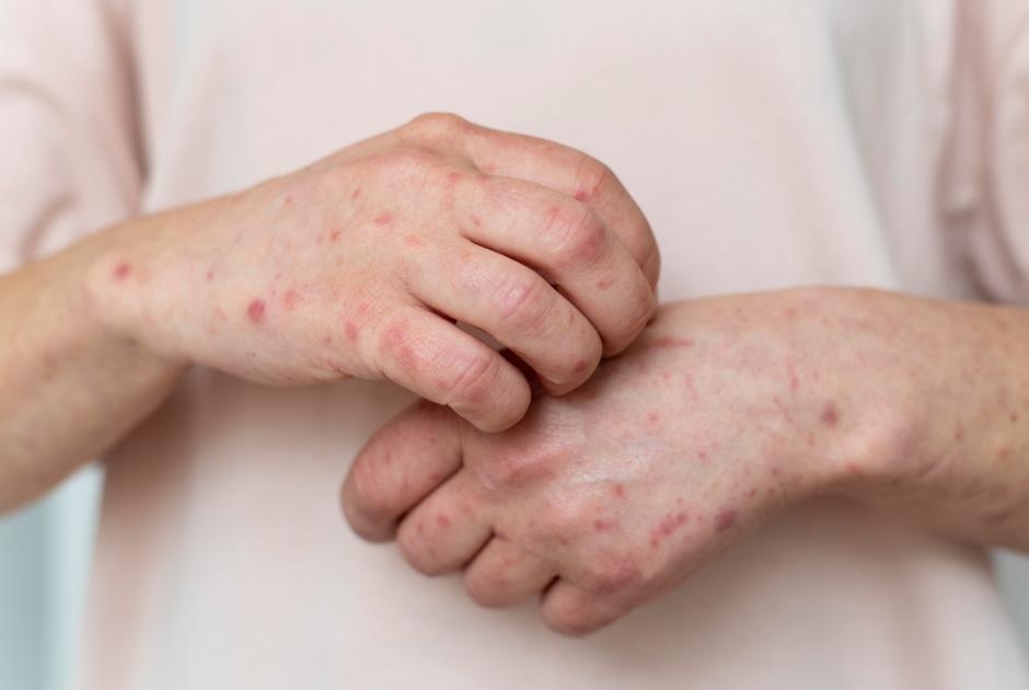 streptokokkos sto derma