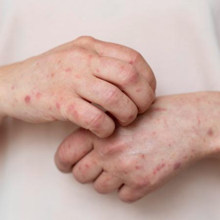 streptokokkos sto derma